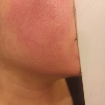 Bioderma Yüzüm Yandı