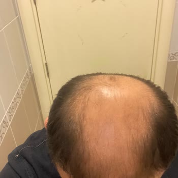 Suit Güzellik Merkezleri Hayal Kırıklığına Uğratan Mezoterapi Süreci