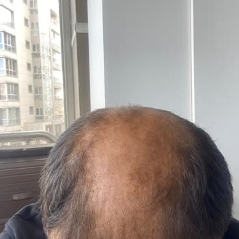 Suit Güzellik Merkezleri Hayal Kırıklığına Uğratan Mezoterapi Süreci