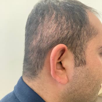 Berkay Tulpar Klinik Doku Küsmesi