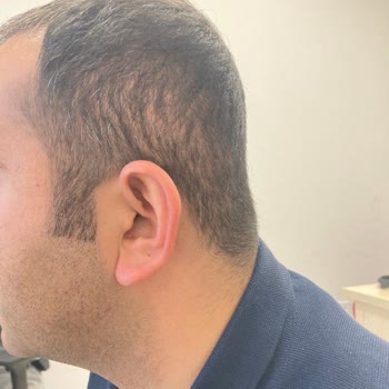 Berkay Tulpar Klinik Doku Küsmesi