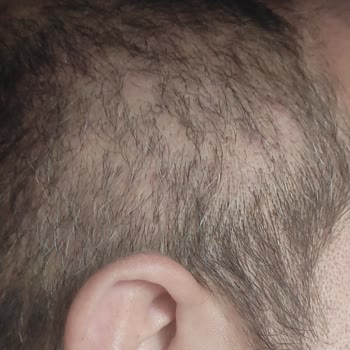 Berkay Tulpar Klinik Doku Küsmesi