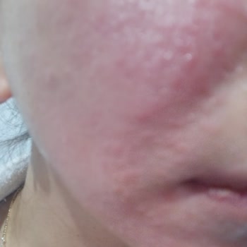 Nivea Egzama Olma Garantili