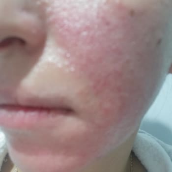 Nivea Egzama Olma Garantili