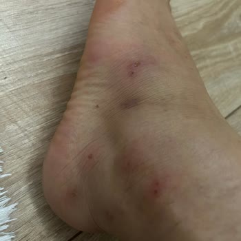 İpekyol'dan Aldığım Ayakkabıdan Uyuz Bulaştı