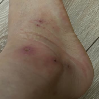 İpekyol'dan Aldığım Ayakkabıdan Uyuz Bulaştı