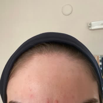 Yves Rocher Elixir Serum Sivilce Yapıyor