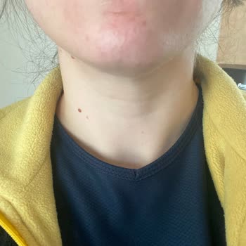 Yves Rocher Elixir Serum Sivilce Yapıyor