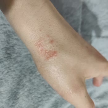 Cerave Nemlendirici Cildimde Egzama Yaptı