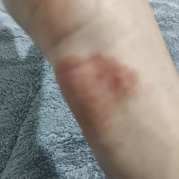 Cerave Nemlendirici Cildimde Egzama Yaptı