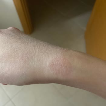 Cerave Nemlendirici Cildimde Egzama Yaptı