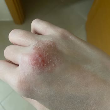 Cerave Nemlendirici Cildimde Egzama Yaptı