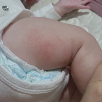 Evolvia Alerji Egzamaya Neden Oldu