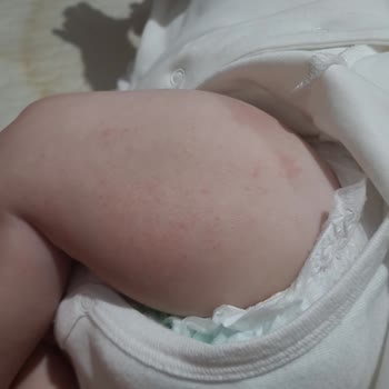 Evolvia Alerji Egzamaya Neden Oldu