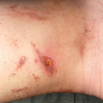 Elif'çe Güzellik Merkezi (Antalya) Lazerde Yaktı