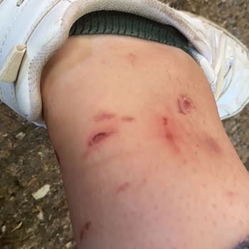 Elif'çe Güzellik Merkezi (Antalya) Lazerde Yaktı