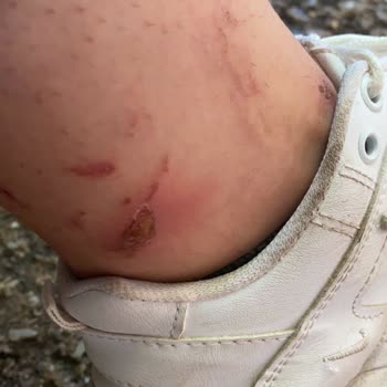 Elif'çe Güzellik Merkezi (Antalya) Lazerde Yaktı