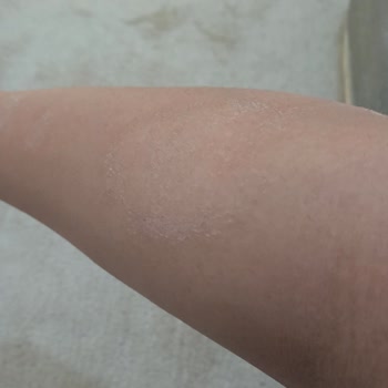 Agiss Tüy Dökücü Köpük Cildime Zarar Verdi!