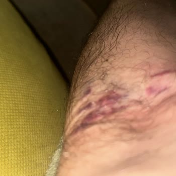 Medical Park Hastanesi Hastanede Hemşire Kaygısı