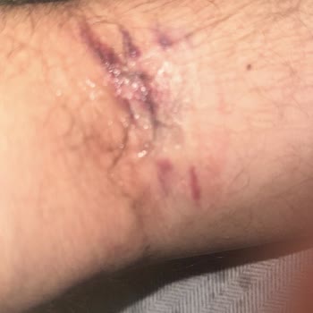 Medical Park Hastanesi Hastanede Hemşire Kaygısı