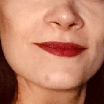 Özel Ekol Hastanesi (İzmir) Burun Ameliyatı Sonucu Yamuk Burun