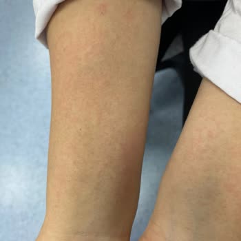 Mustela Çatlak Kremi Alerji Yaptı