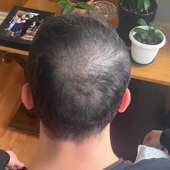 Üsküdar HospitalTürk Hospitaltürk Saç Ekimi