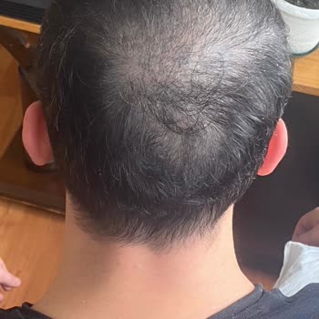 Üsküdar HospitalTürk Hospitaltürk Saç Ekimi