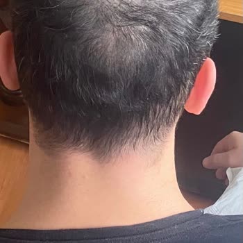 Üsküdar HospitalTürk Hospitaltürk Saç Ekimi