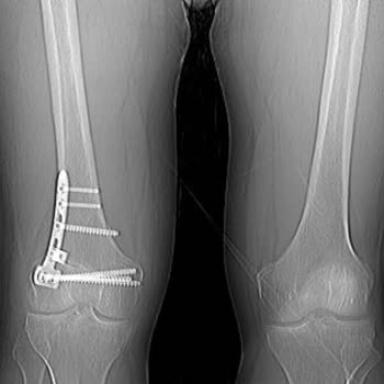 Anadolu Hastanesi (Silivri, Avcılar, Ereğli) Yanlış Bacak Diz Ameliyat