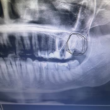 Enesdent Ağız ve Diş Sağlığı Polikliniği 20 Diş Çekiminde Yaşanan Tıbbi İhmal