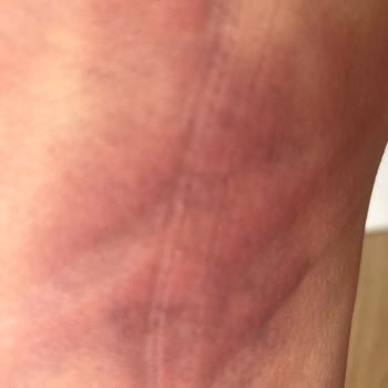 Eylül Öztürk Nail Spa G5 İşlemi Sonrası Morarma Ve İade Problemi