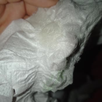 Bebem Natural Bezde Sertlik Var Ve Sızdırıyor