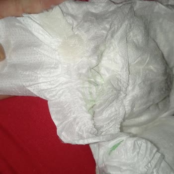 Bebem Natural Bezde Sertlik Var Ve Sızdırıyor