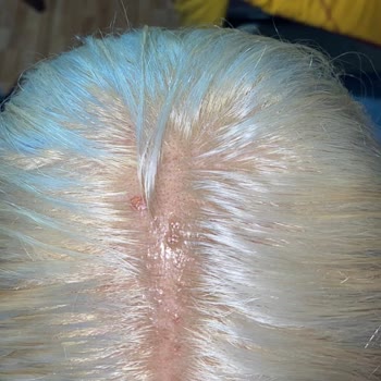 Palette Saç Boyası Kullanımı Sonrası Yaşanan Cilt Problemleri