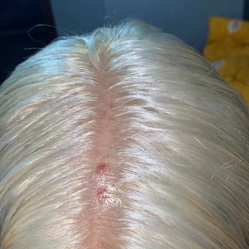 Palette Saç Boyası Kullanımı Sonrası Yaşanan Cilt Problemleri