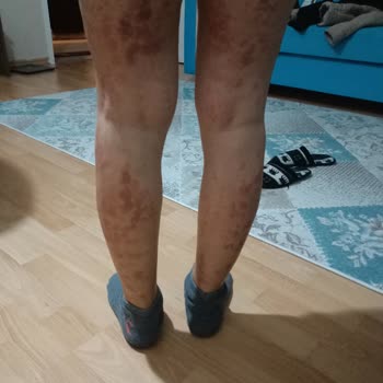 As Estetik (İstanbul) Lazer Epilasyon Sonrası Ciddi Yanıklar