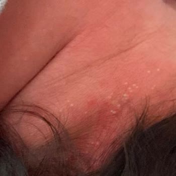 Incia Bebeğime Alerji Yaptı