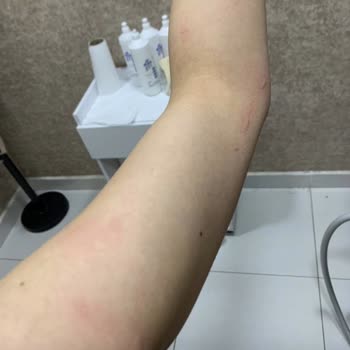 İstanbul Clinic Epilasyon Mağduriyeti Ve Hukuki Süreç