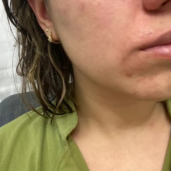 Yves Rocher Pure Menthe Yüz Yıkama Jeli Yüzümü Yaktı