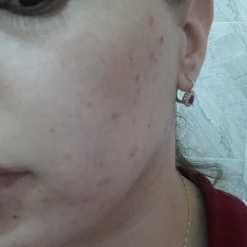 Atomy Kore Ürünleri Kullanım Sonrası Hayal Kırıklığı