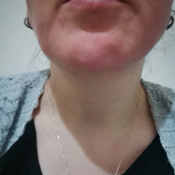 Eyüp Sabri Tuncer Gül Suyu Alerji