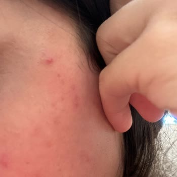 Missha Güneş Kremi Sivilcelendirdi