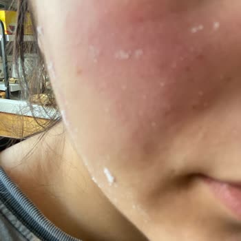 La Roche Posay Effaclar Duo Cildimi Yaktı