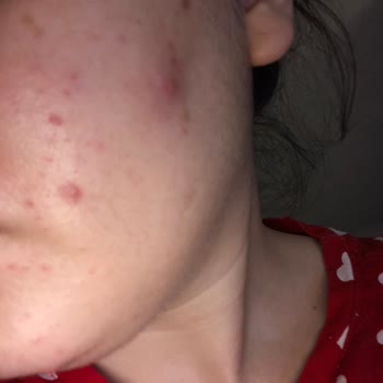 La Roche Posay Effaclar Duo+m Yüzümü Mahvetti!