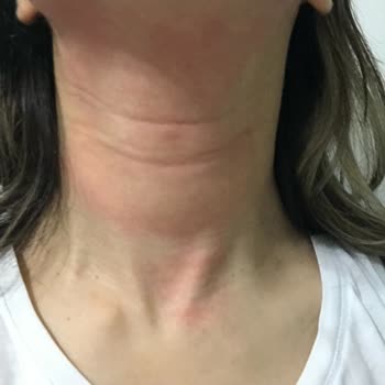 Clinique Krem Cildimde Alerji Yaptı