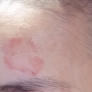 Clinique Krem Cildimde Alerji Yaptı