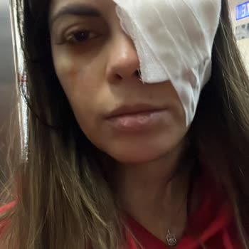 Diva Dermal Güzellik Merkezi İpek Kirpik Kornea Yırtılması