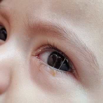 Mustela Banyodan Sonra Gözlerde Akma Şişme