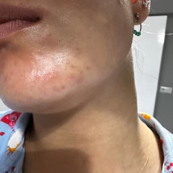 Kurtsan İlaçları Ciltte Yanma Kızarıklık